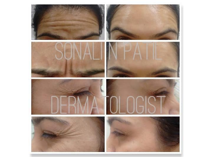 Botox Job