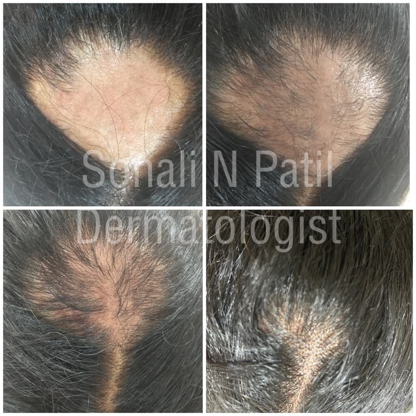 Hair Loss
