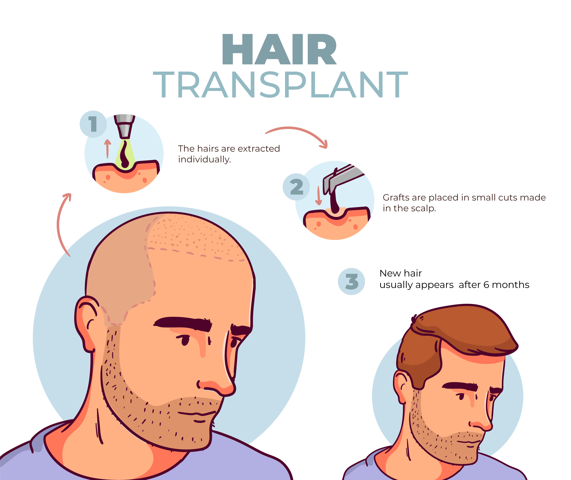 Hair Transplant in Indira Nagar Nashik