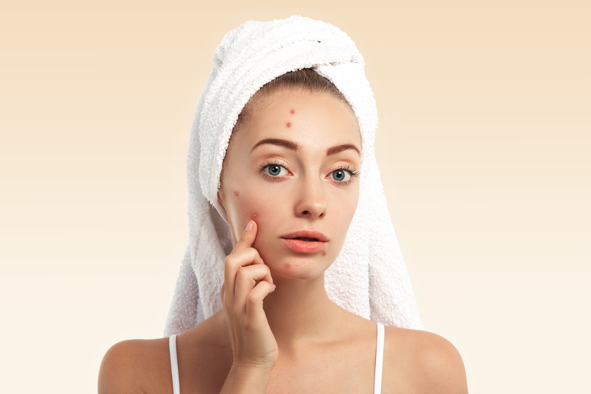 Pimples Treatment in Gangapur Road Nashik