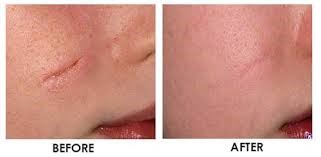Scar Laser Treatment in Nashik